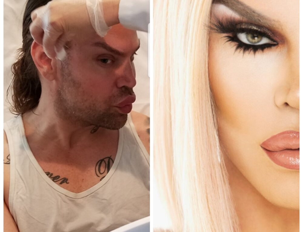 Lip Fillers Los Angeles, Eureka O'Hara, Dr. Michele Ware Los Feliz Medspa