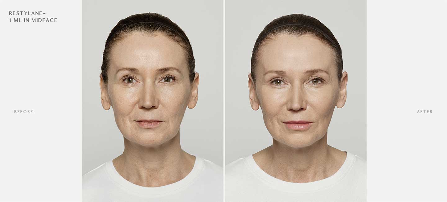 Restylane Before and After Sample 3