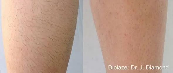 InMode Triton Hair Removal Los Angeles Before and After Sample 2
